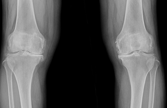 무릎 퇴행성 관절염