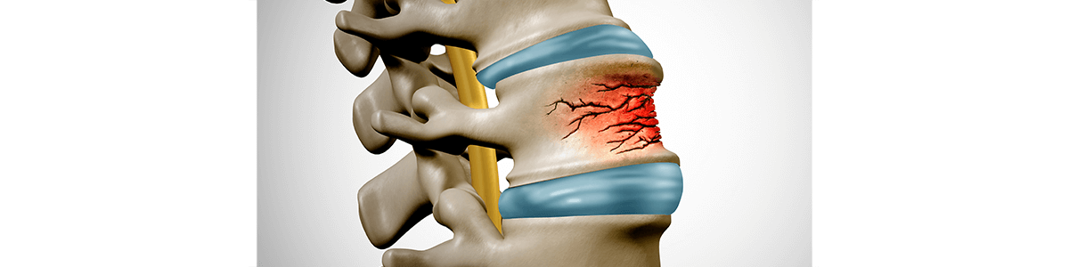 척추 압박골절